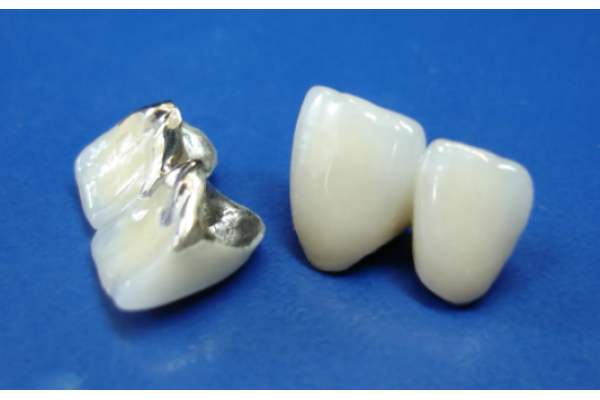 Коронка зуба металлокерамическая (без слепков, фиксации, ретракции)