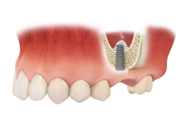 Костная пластика при имплантации зубов