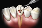 Лечение зуба после пульпита