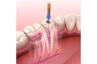 Лечение пульпита однокорневого зуба