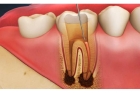 Лечение пульпита 4 зуба