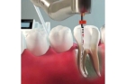 Лечение пульпита зубов с несформированными корнями
