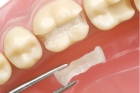 Пломба на 2 зуба