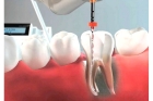 Удаление 8 зуба