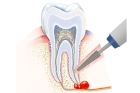Лечение кисты зуба кальцием