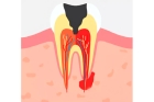 Лечение кисты корня зуба