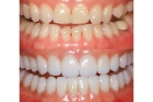 Художественная реставрация передних зубов