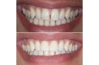 Художественная реставрация фронтальной группы зубов композитным материалом