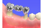 Мостовидные коронки на зубы
