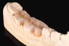 Коронка на коренной зуб