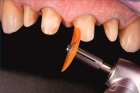 Восстановление зуба под металлокерамической коронкой