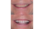 Металлокерамические коронки на жевательные зубы