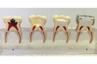 Депульпирование зуба протезирование