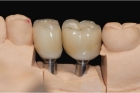 Протезирование 6 зуба