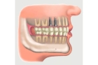 Протезирование верхних жевательных зубов