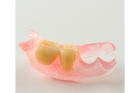 Протезирование двух зубов