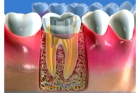 Протезирование корня зуба