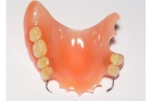 Протезирование зубов пластиночным протезом