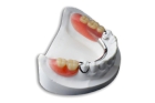 Протезирование зубов бюгельным протезом