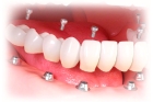 Протезирование зубов на импланте металлической коронкой