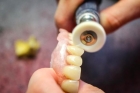 Искусственные зубы в съемном протезе