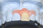 Съемный протез на 1 зуб