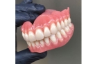 Съемный протез при отсутствии зубов