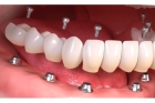 Несъемные протезы передних зубов
