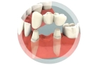 Несъемный протез на 6 зубов