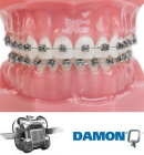 Ортодонтическое лечение с применением самолигирующей брекет системой Damon Q (одна челюсть)
