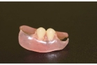 Съемный протез на 2 зуба